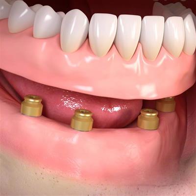 Fixed Dentures (implant supported)